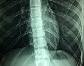 X-ray of spine | Spinal Cord Injury Lawyers